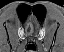 סריקת MRI של המוח ברמת ה- olfactory bulb