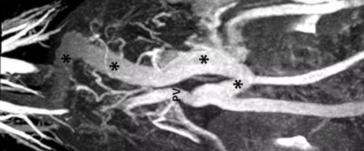 Portosystemic (liver) shunts