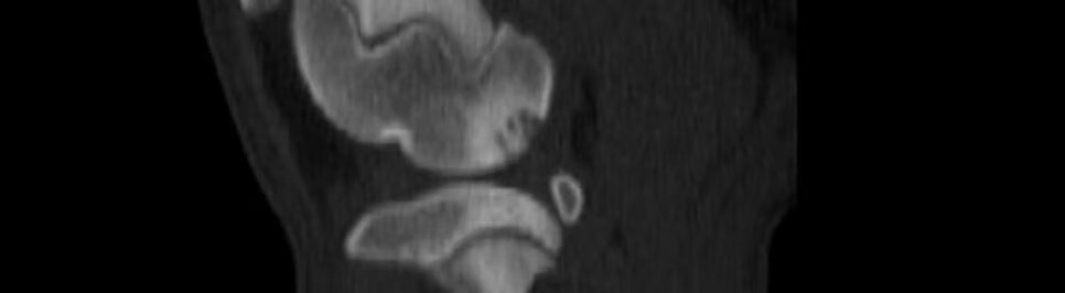 Osteochondrosis