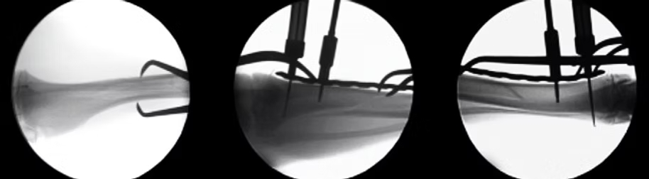 Minimally Invasive Osteosynthesis Technique