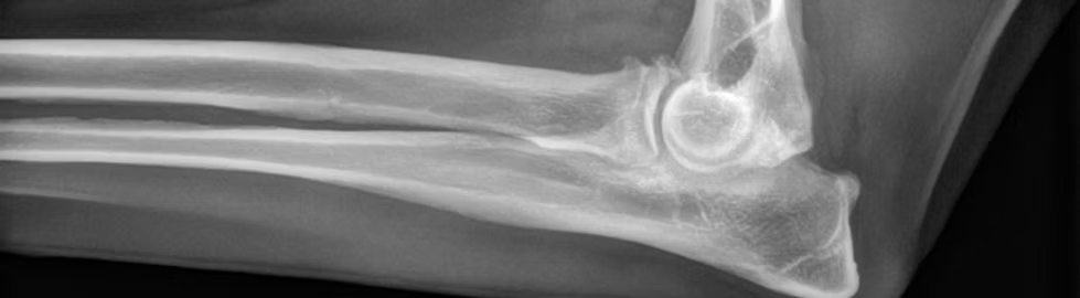 Elbow dysplasia