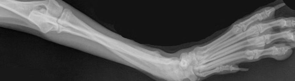 Angular limb deformity